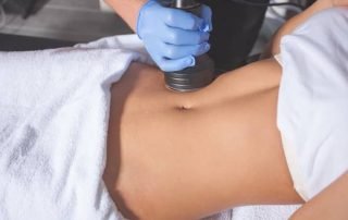 What is CoolSculpting